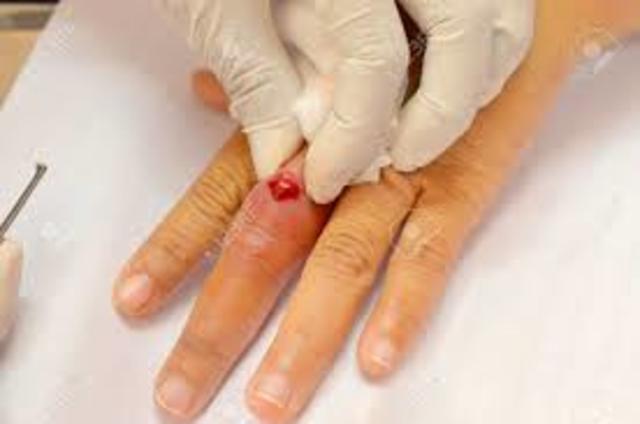 doctor proposed puss in wounds is bad