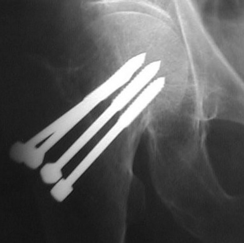 Tratamiento Osteosintesis con clavos de Knowles