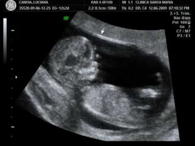 Semana 12 de embarazo