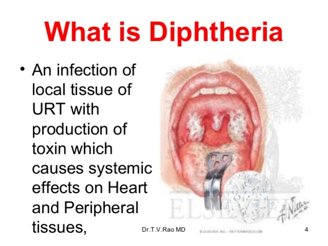 First vaccine for diphtheria