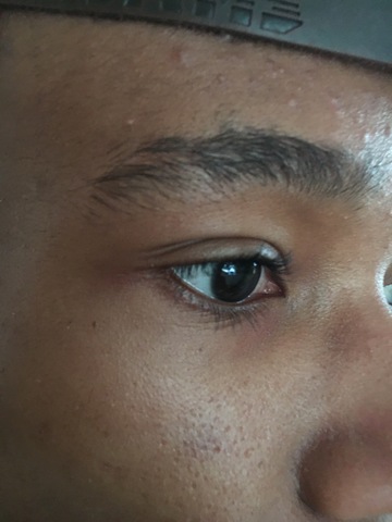 First time getting stitches