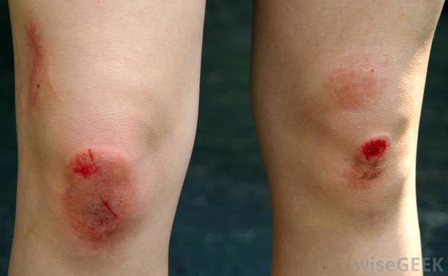 Scraping knee at Brians house