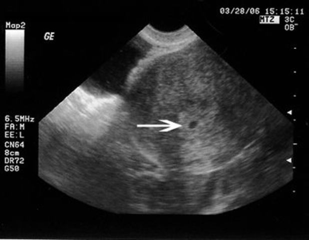 Month 1 Development of The Baby