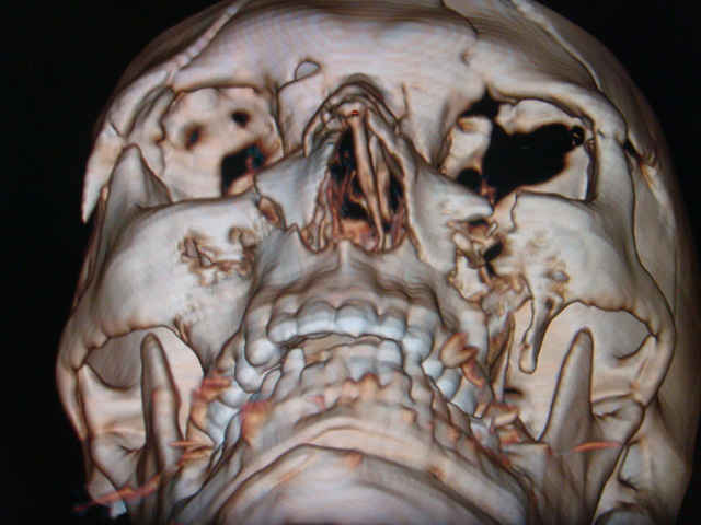 Accidente de mi Papá