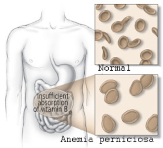 Anemia Perniciosa
