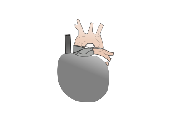 EL CORAZON ARTIFICIAL