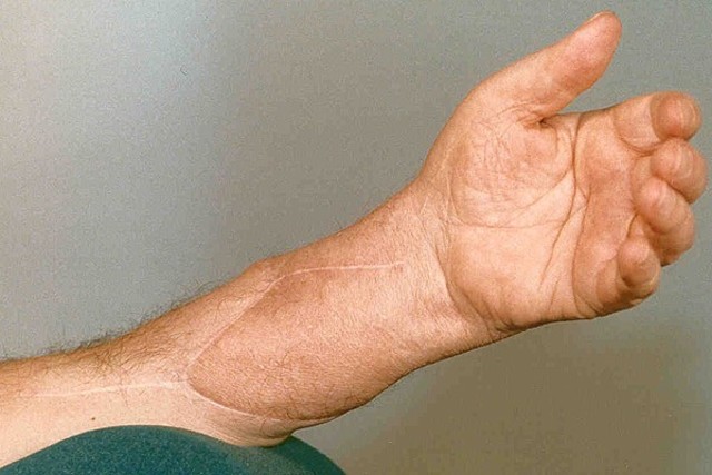 Primer implante de mano