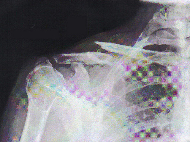 Broke my collar bone