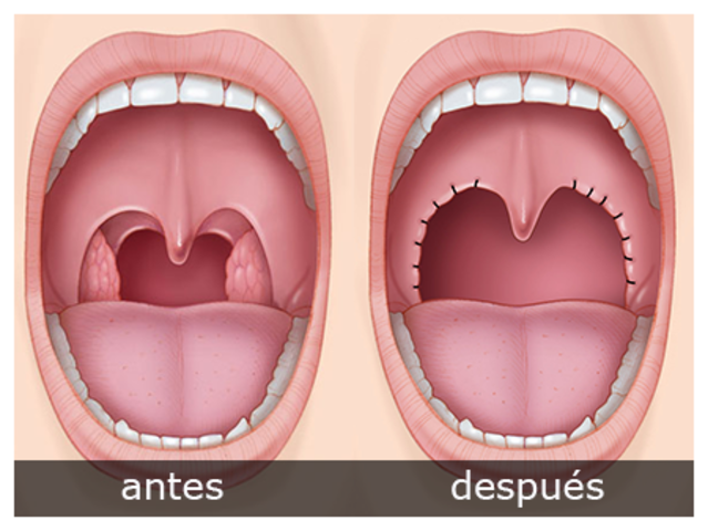 OPERACIÓN POR AMIGDALITIS