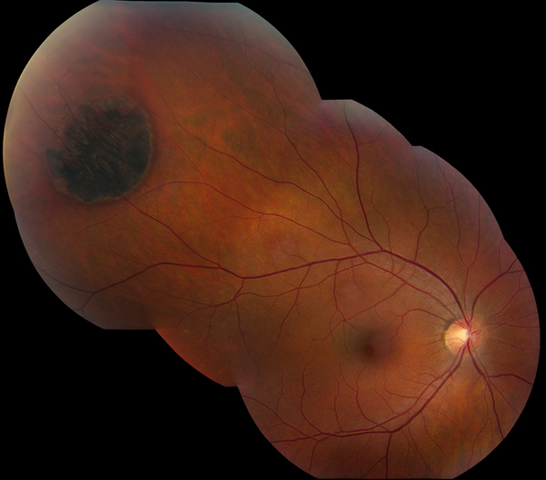 LASER used for medicine