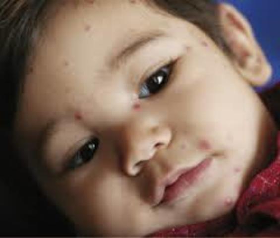 Me da Varicela en mi primer cumpleaños