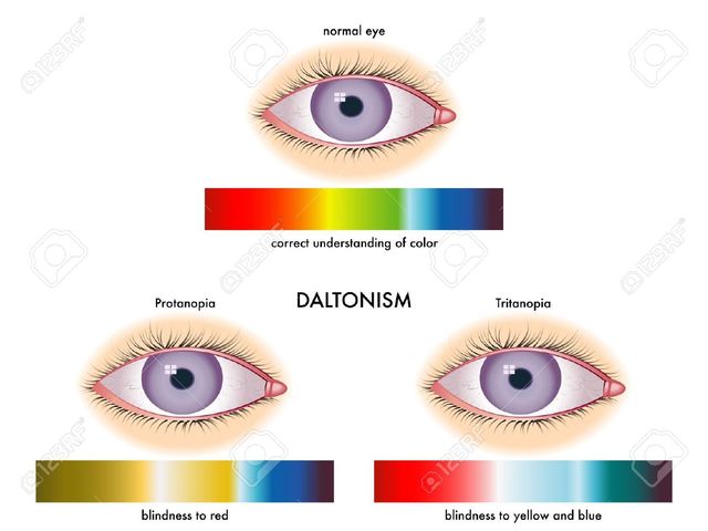 While at MLAPS, Dalton delivered his first paper on color blindness, called Daltonism