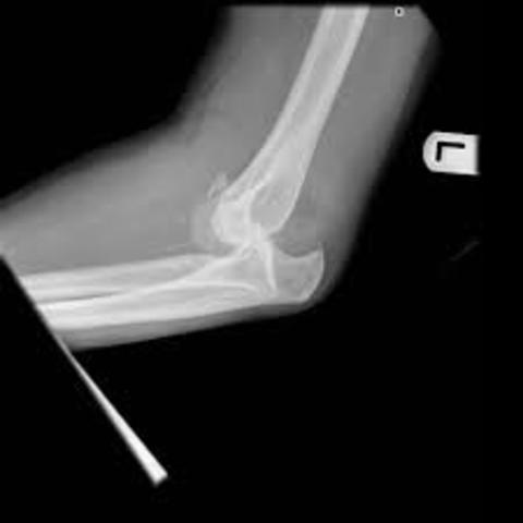 Firth time to break a bone