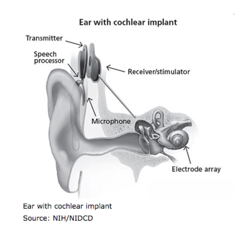 Cochlear Implants Today
