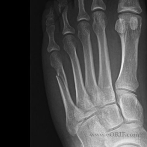 Broke my left metatarsal