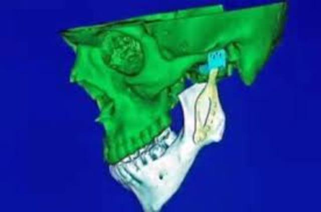 The first prosthetic jaw is implanted
