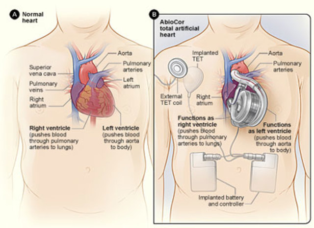 The AbioCor Artificial Heart is introduced