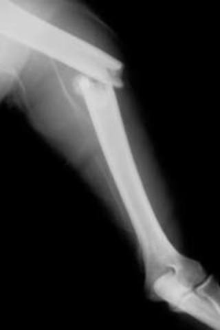 Broken Bone