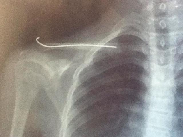 La primera vez que me operaron