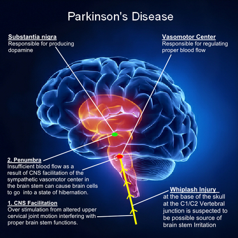 Parkinson's disease