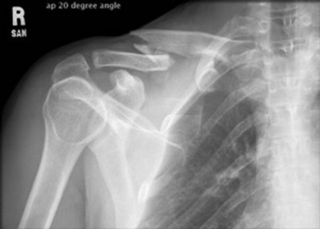 Broke Collar Bone