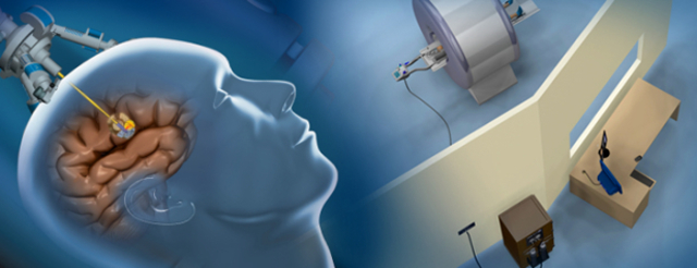 2008 - French neurosurgeons use fibre optic lasers and keyhole surgery to destroy brain cancer