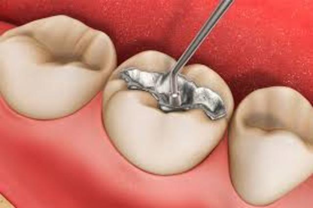 1816-Primera amalgama