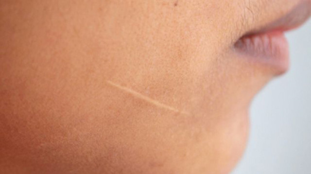 La meva primera cicatriu.