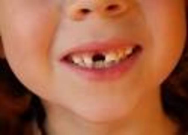 Em cau la primera dent