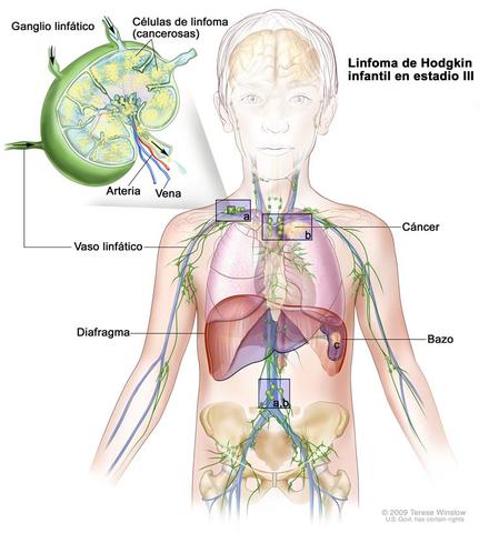 Supera el cancer por segunda vez:Cancer Linfatico