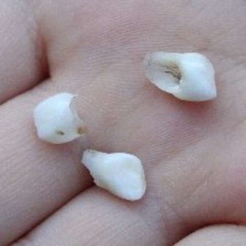 Lost first tooth