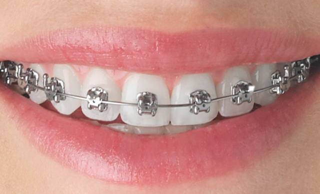 my first braces