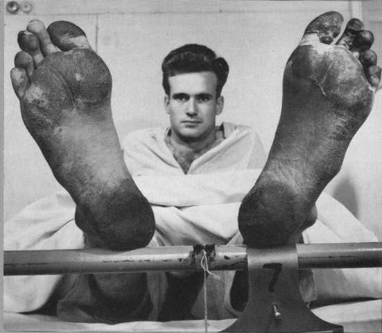 Trench Foot