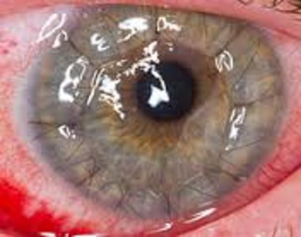 corneal transplant