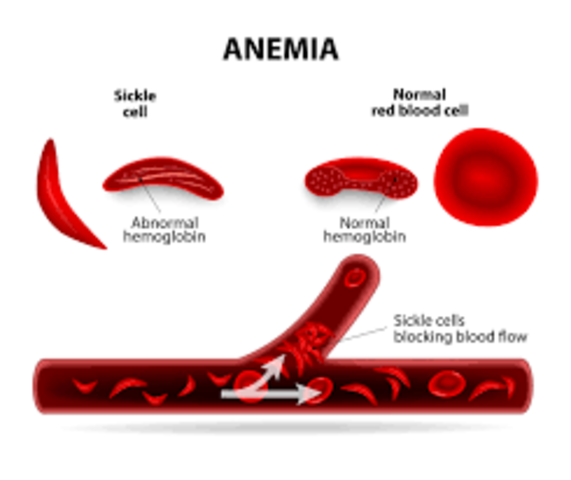 anemia cure