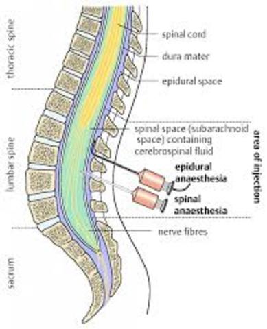 Smith and Porter spinal anesthesia