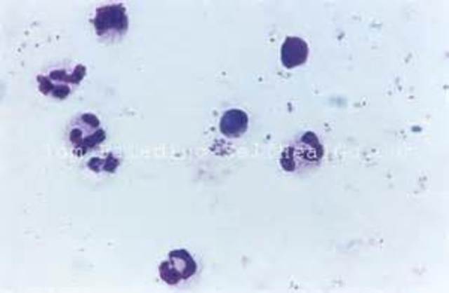 Plasmodium falciparum is described as the causative agent of malaria