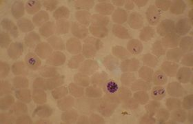 Plasmodium falciparum is described as the causative agent of malaria