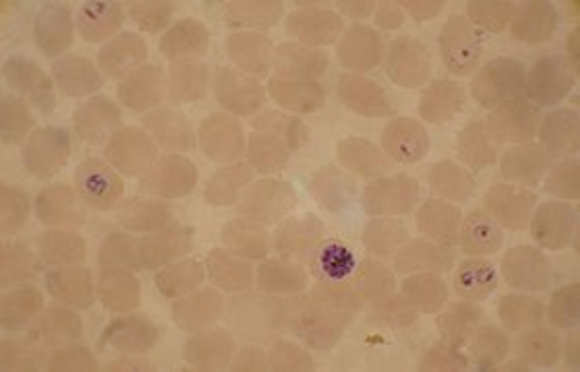 Plasmodium falciparum is described as the causative agent of malaria