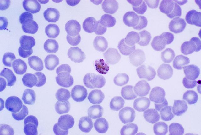 Plasmodium falciparum is described as the causative agent of malaria