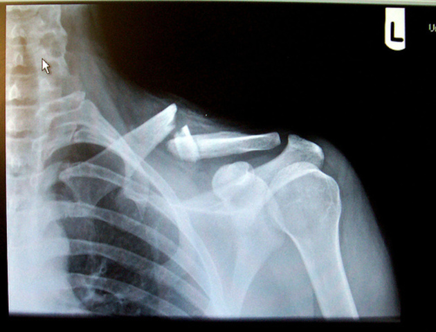 i broke my coller bone