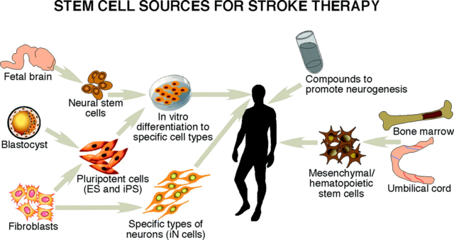 Des cellules souches injectées dans des patients atteints d'AVC permettent à un patient de marcher à nouveau