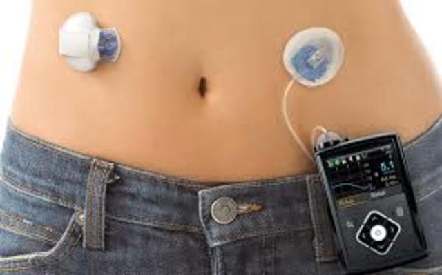 Insulin Pump