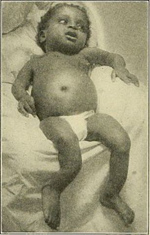 Escorbuto y Raquitismo