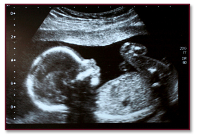 Prenatal (Conception to Birth)