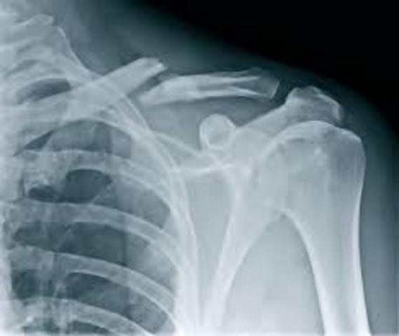 Broke collarbone while skiing (also bruised thumb bone)