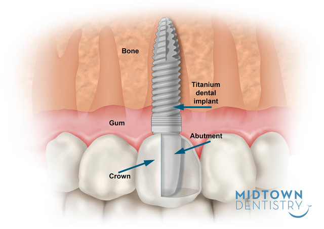 Dental implants all on 4