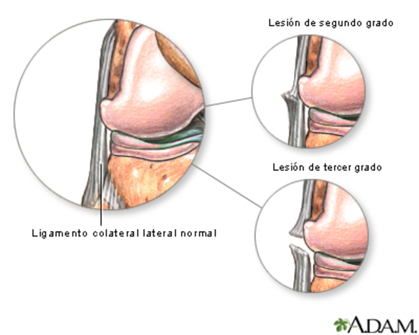 Lesión ligamentosa