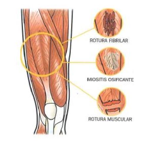 Lesiones musculares
