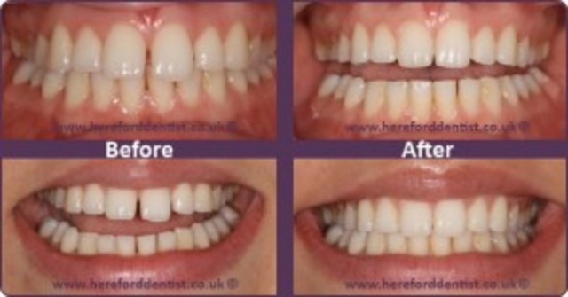 Got Braces Taken Off